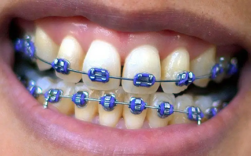 aparaty ortodontyczne