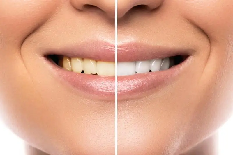 efekt przed i po wybielaniu zębów