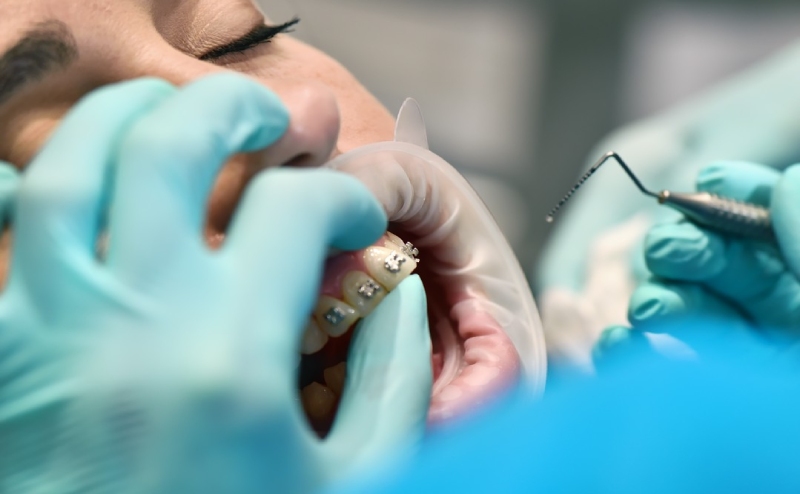 zakładanie aparatu ortodontycznego